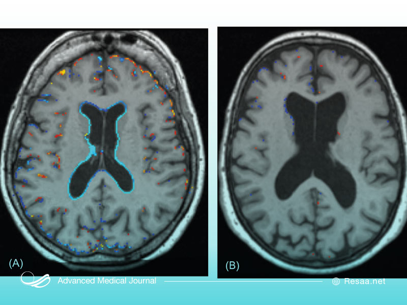 زوال عقل عروقی