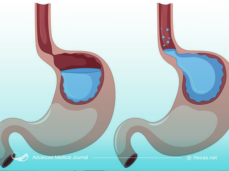 تصویری از معده و اسید معده