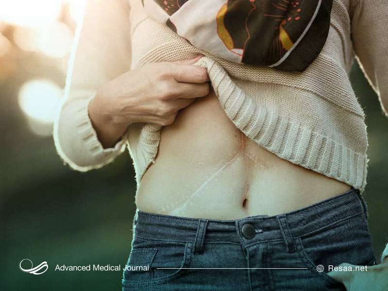 شرایط عمل پیوند کبد