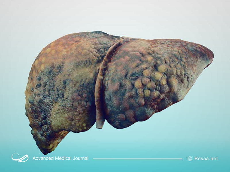 زندگی با کبد پیوندی