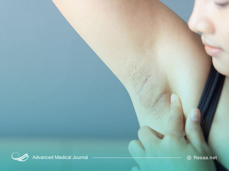 نمونه برداری از غدد لنفاوی