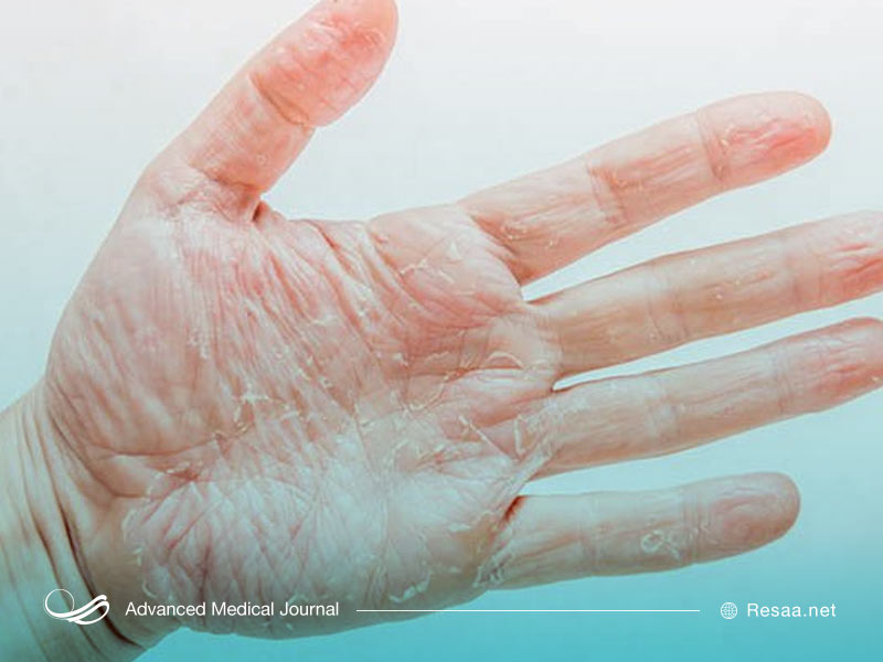 پوست پوست شدن دست به دلایل مختلفی از جمله اگزما یا شستن مکرر دست‌ها اتفاق میفتد.