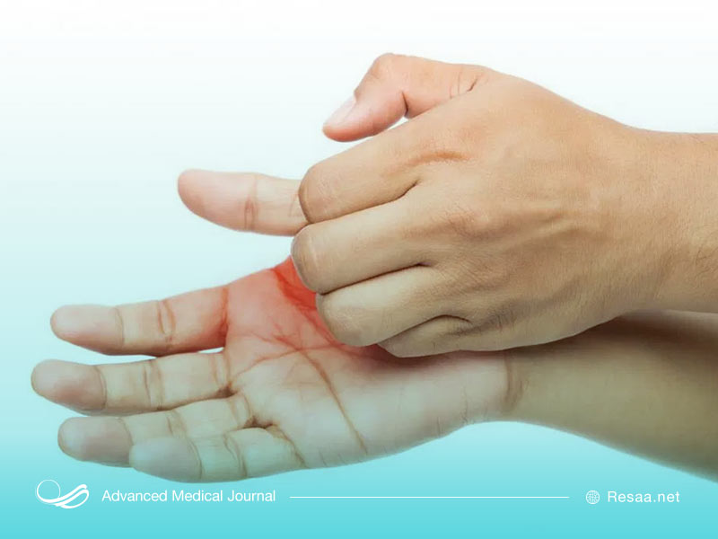 آفتاب سوختگی باعث پوست پوست شدن کف دست ها میشود.