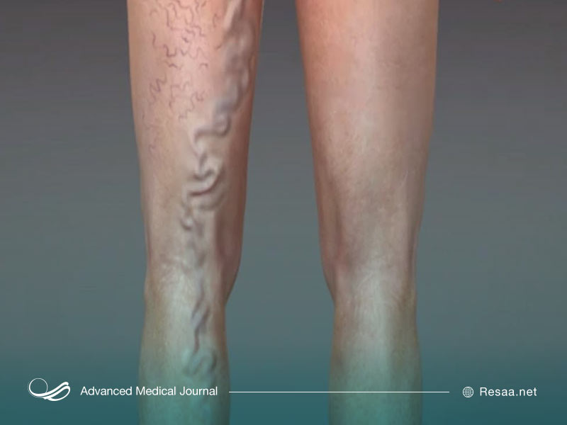 واریس یا آسیب دیدگی رگها