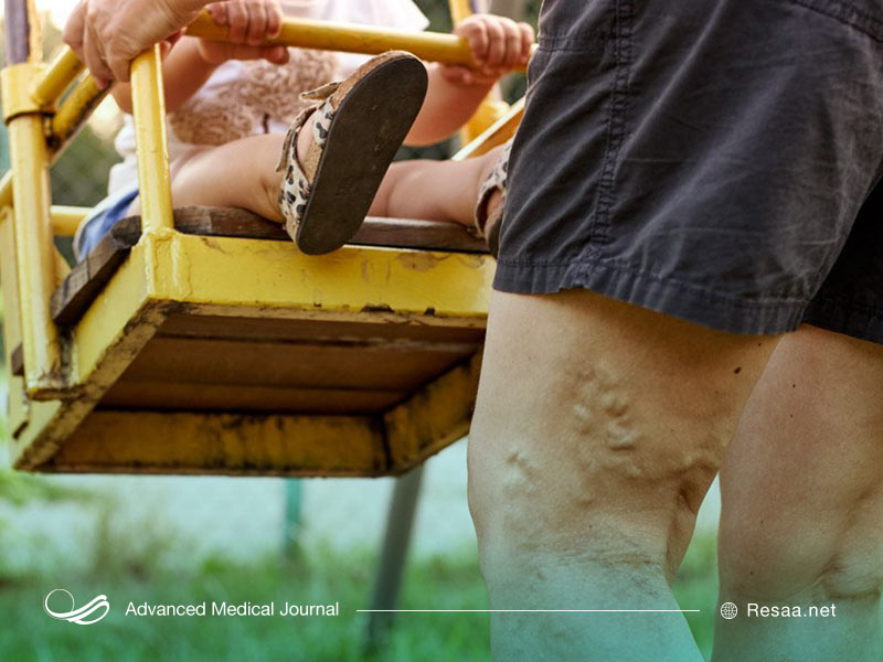 درمان دارویی واریس