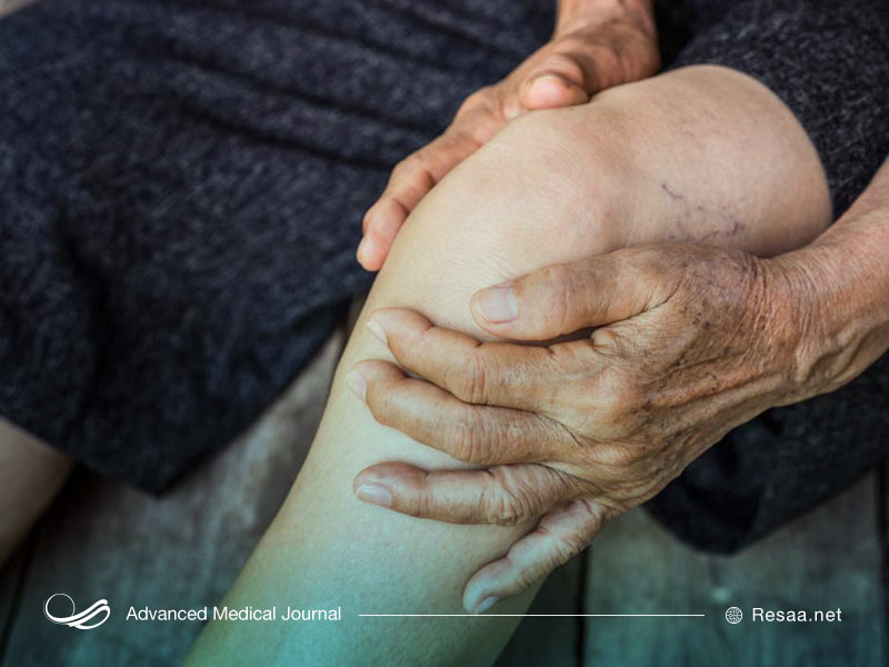 نشانه های واریس در بدن