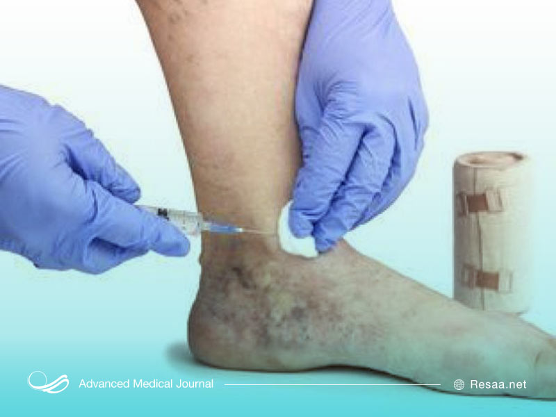 داروهای موثر بر واریس