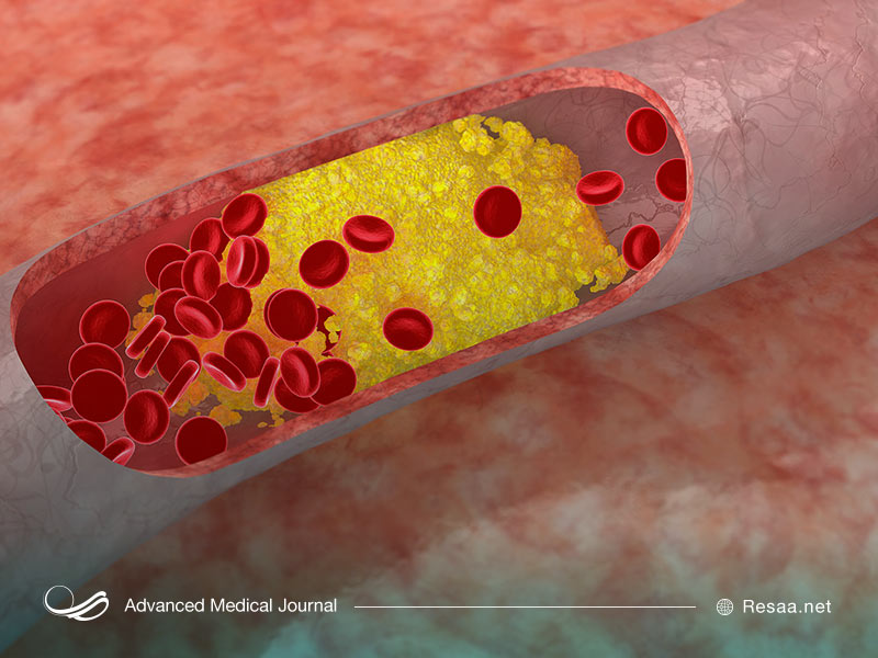 گرفتگی رگها