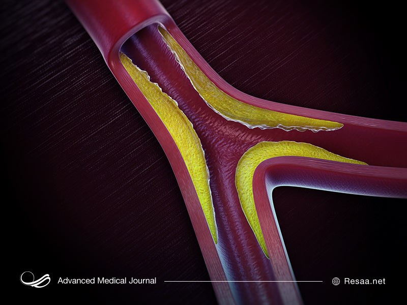 سخت شدن رگها