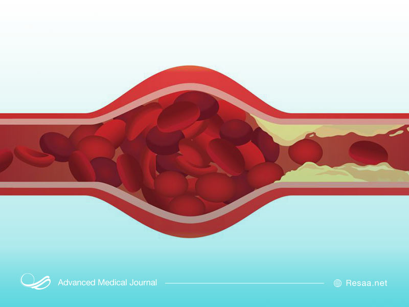 گرفتگی رگها