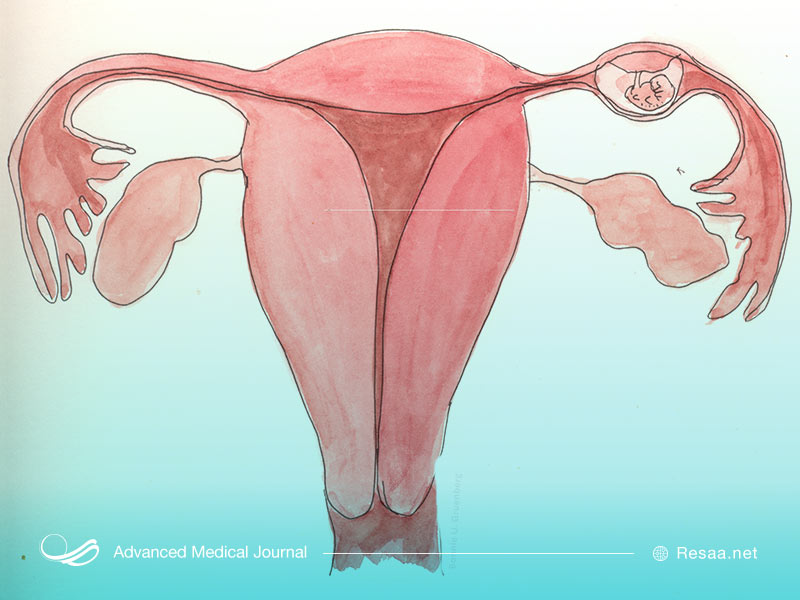 حاملگی خارج رحمی