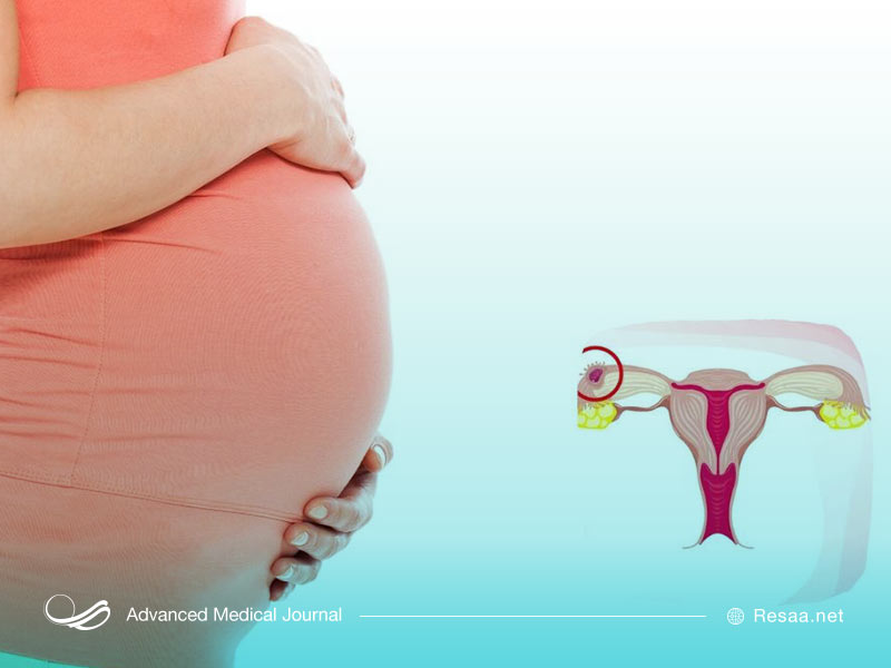 پیشگیری از حاملگی خارج رحمی