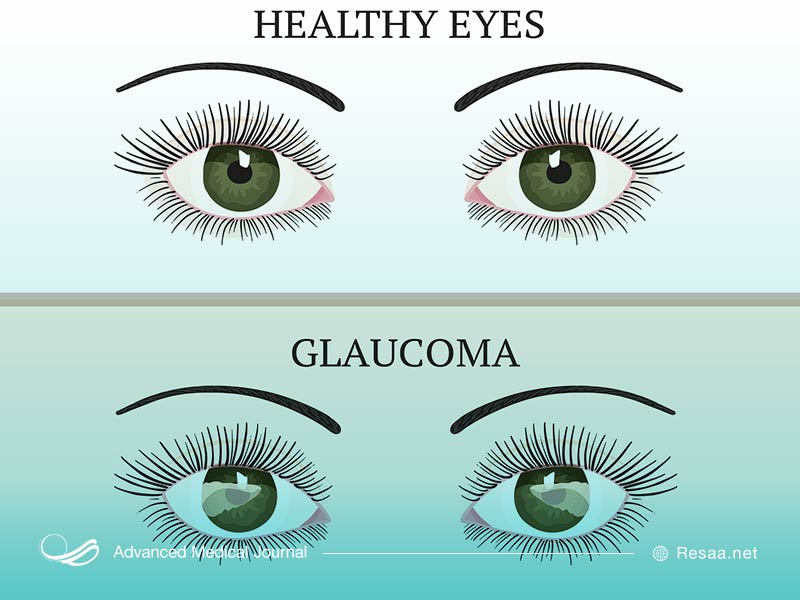 بیماری اب سیاه چشم