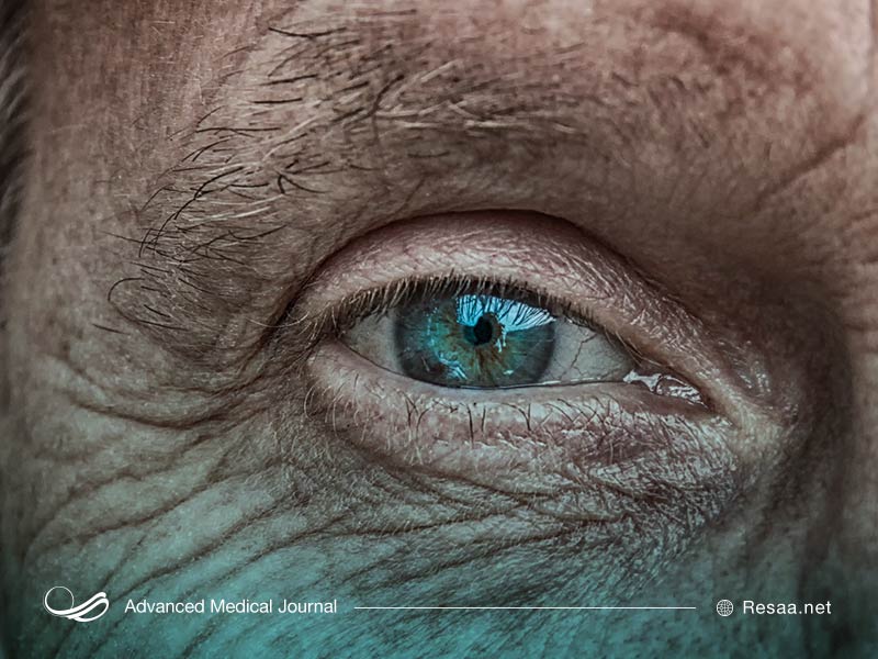 نشانه های گلوکوم یا اب سیاه