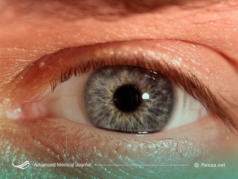 عوامل موثر بر گلوکوم