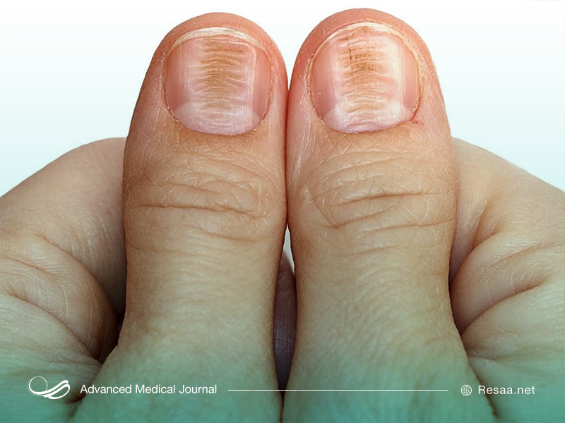 بری بری در اثر کمبود تیامین در بدن ایجاد می‌شود.