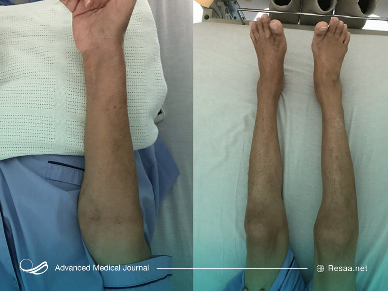 بری بری ریشه ژنتیکی دارد