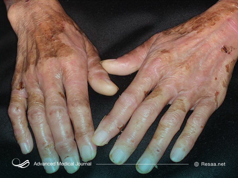 جهت تشخیص بیماری نیاز به آزمایش خون می‌باشد.