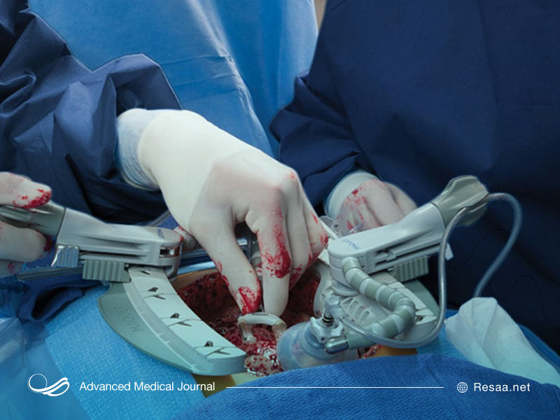 تشخیص نیاز به جراحی بای پس