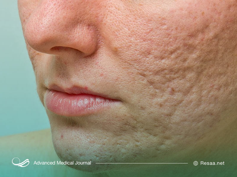 علت ایجاد جوش صورت