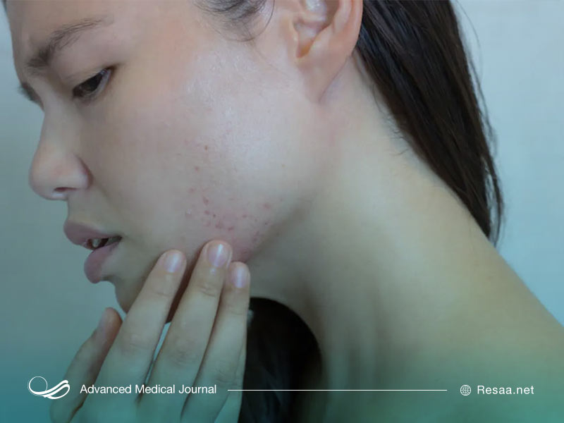 علت جوش‌های صورت