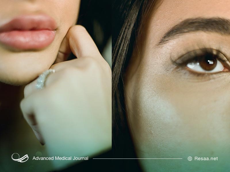 تزریق ژل لب