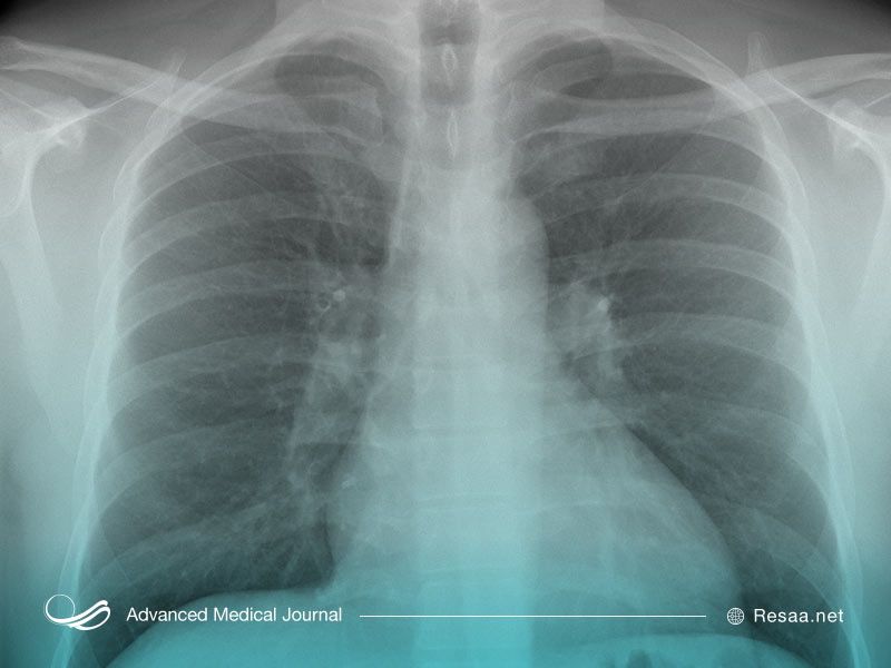 تصویر قفسه سینه