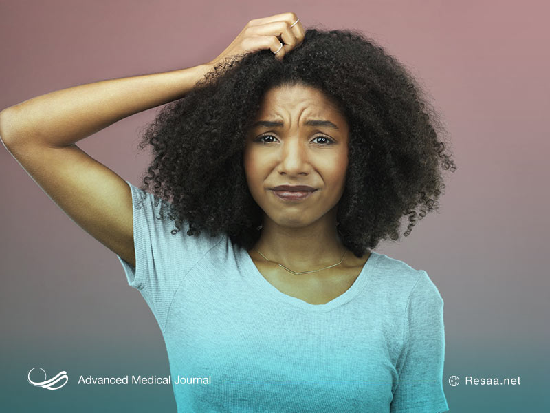 درمان شوره سر