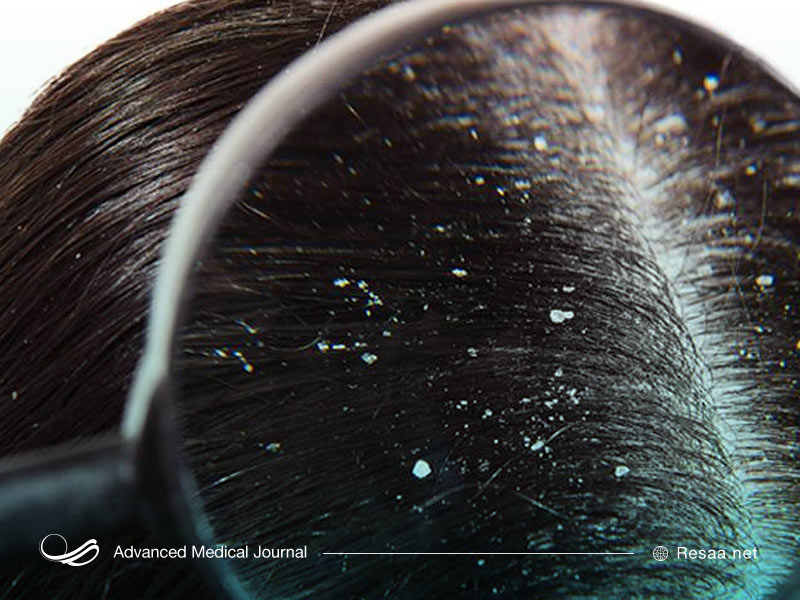 شوره سر چرا ایجاد میشود؟