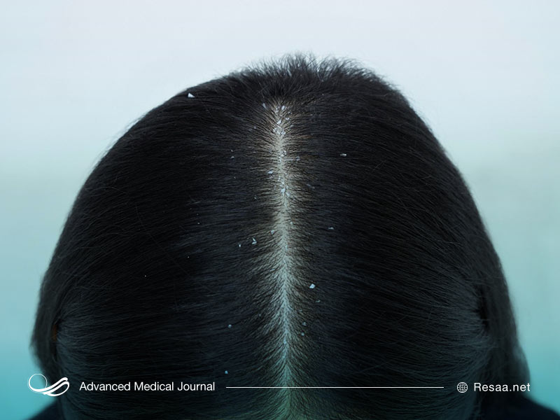 چرا دچار شوره سر میشویم