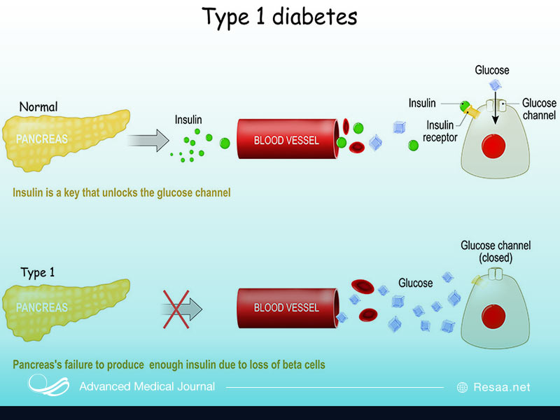 دیابت نوع یک بیشتر در بین نوجوانان دیده می‌شود