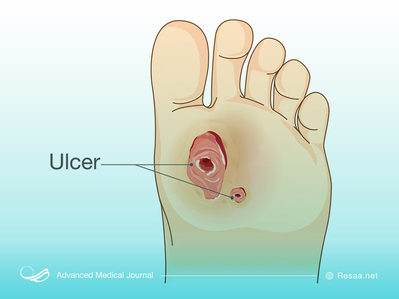 زخم پای دیابتی