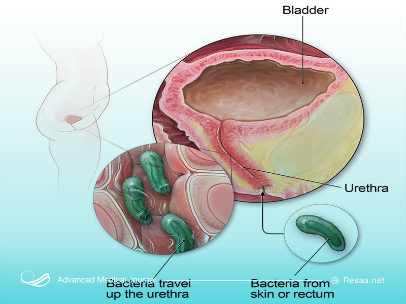 عفونت‌های ادراری