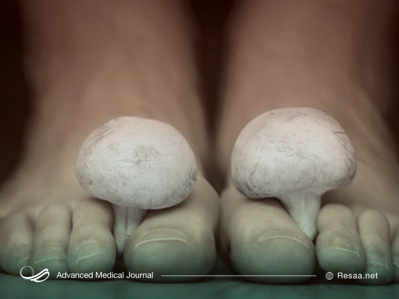 عفونت‌های قارچی در بیماران دیابتی