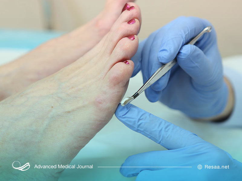 اعصاب محیطی در افراد دیابتی