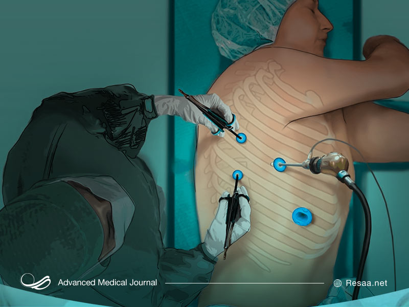 توراکوسکوپی