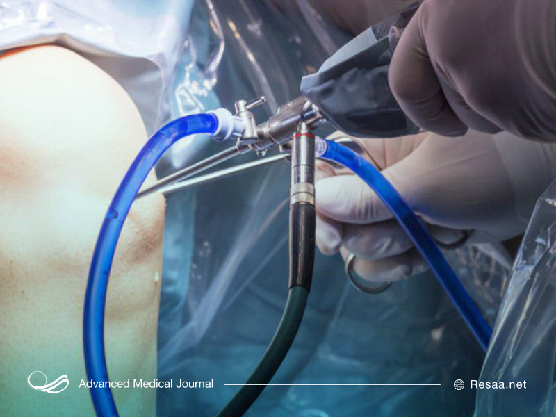 آرتروسکوپی