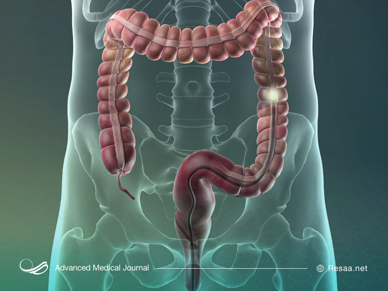 کولونوسکوپی