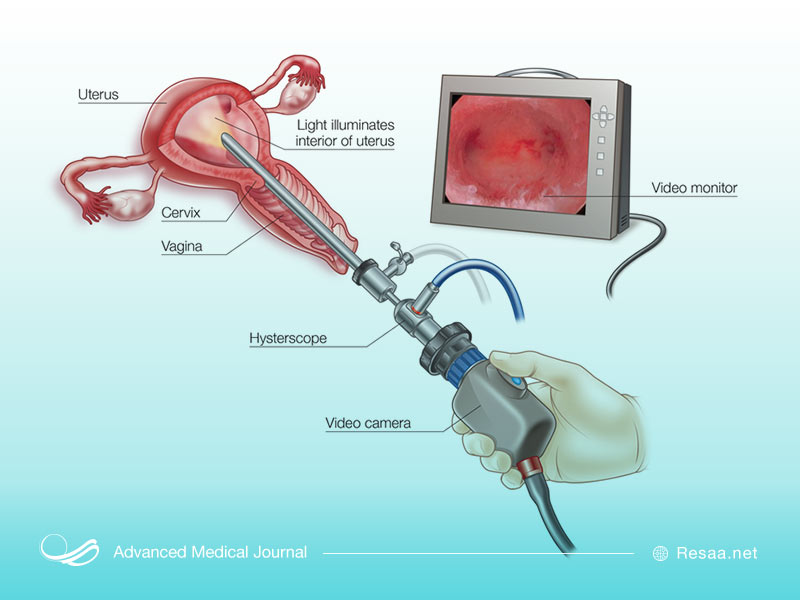 هیسترسکوپی