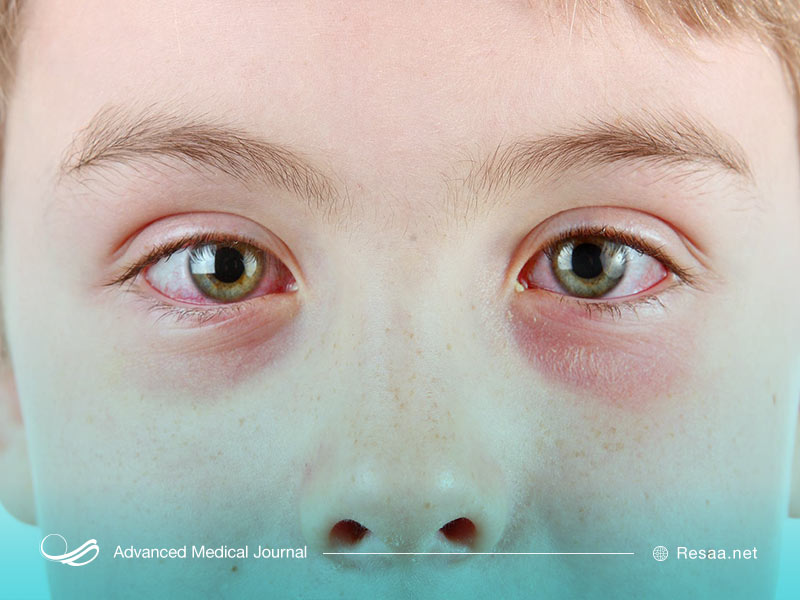 قرمزی چشم ها