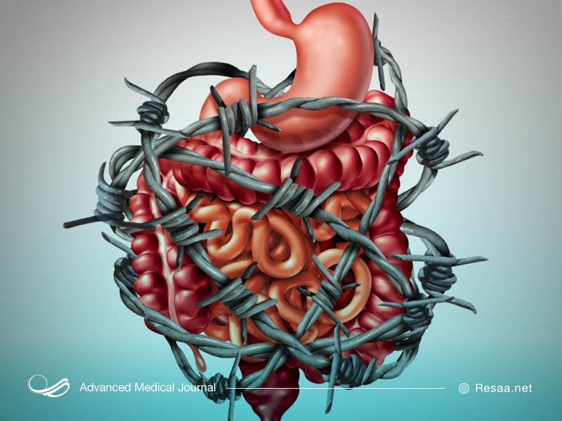 علایم روده تحریک پذیر