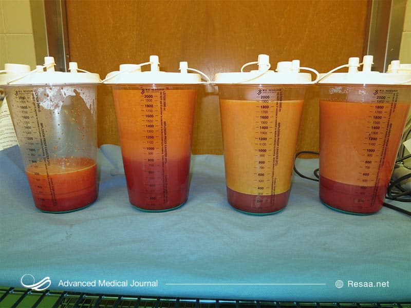 لیپوساکشن برای همه افراد توصیه نمیشود