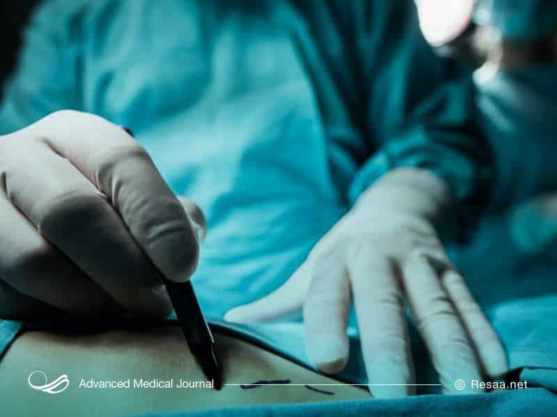 عوارض عمل لیپوساکشن