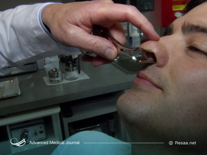 پولیپ بینی چیست