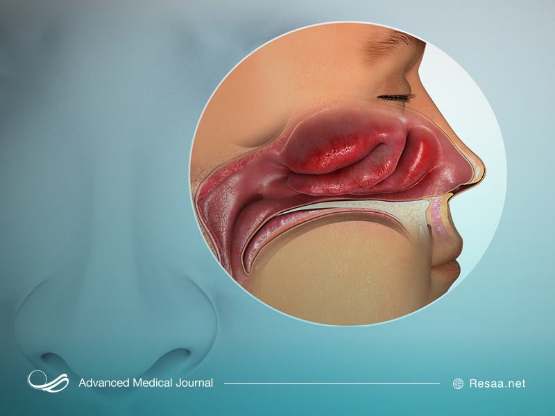 مشکلات ناشی از پولیپ