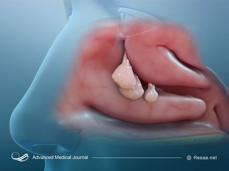 علائم پولیپ بینی چیست