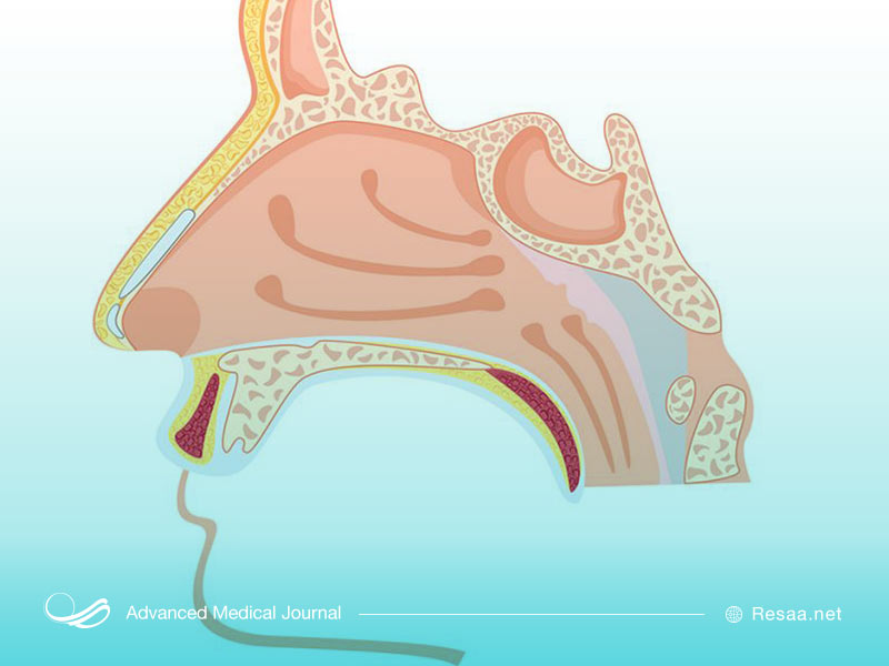 پیشگیری از ایجاد پولیپ