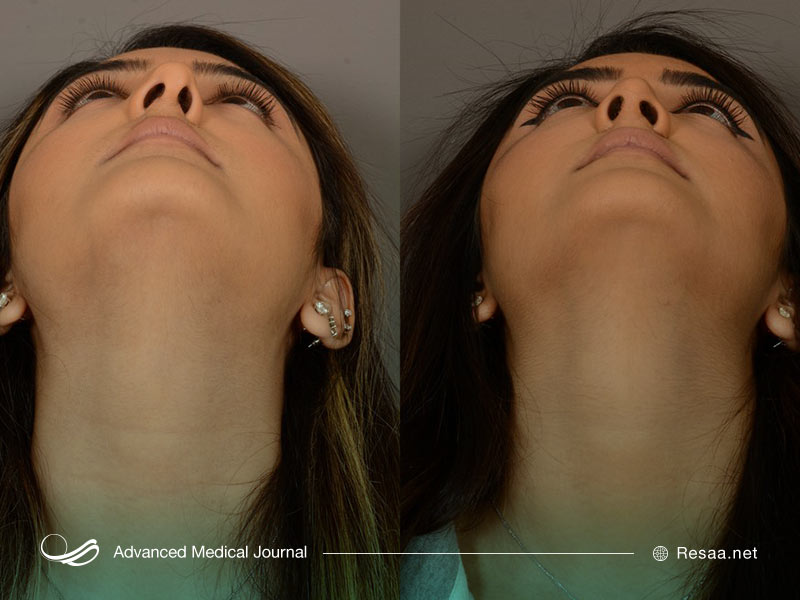 تصویر قبل و بعد از سیتوپلاستی