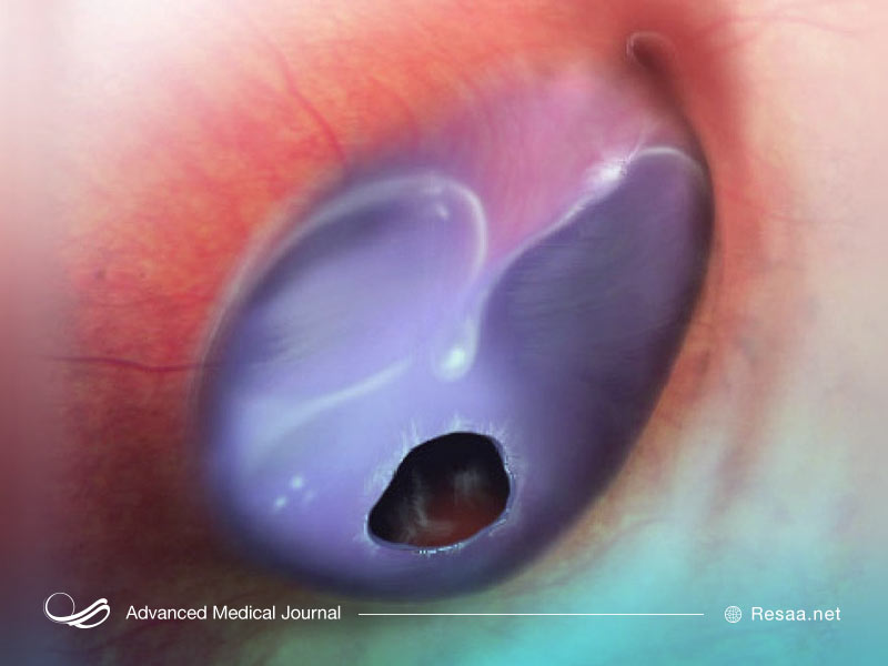 پارگی پرده گوش