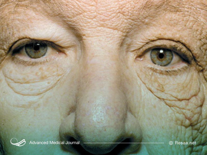 پیشگیری از پیری زودرس